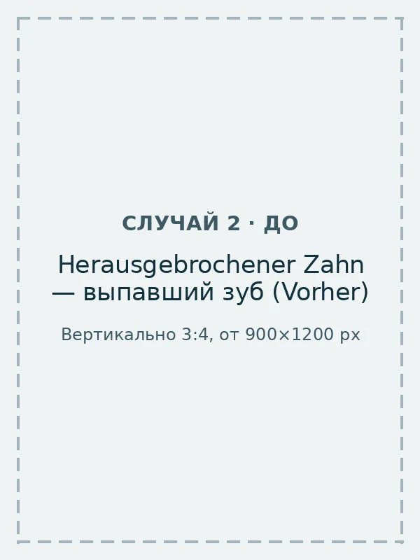 Prothese mit herausgebrochenem Zahn vor der Reparatur